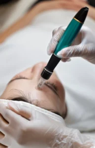 microneedling with exosomes