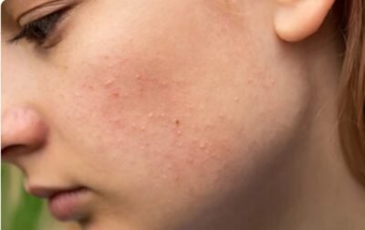 Fungal Acne vs Hormonal Acne and Causes, Treatments & Skin Solutions